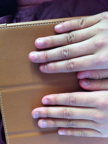 我女儿总乐意扣手指甲,把指甲快弄没有了