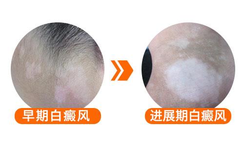 身上长白颠疯怎么治疗必问兰州中研