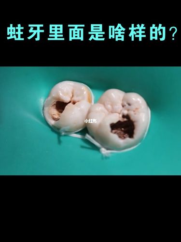 蛀牙_植得口腔医院(总院)自由行热门攻略_牙齿保护_口腔_牙齿保护