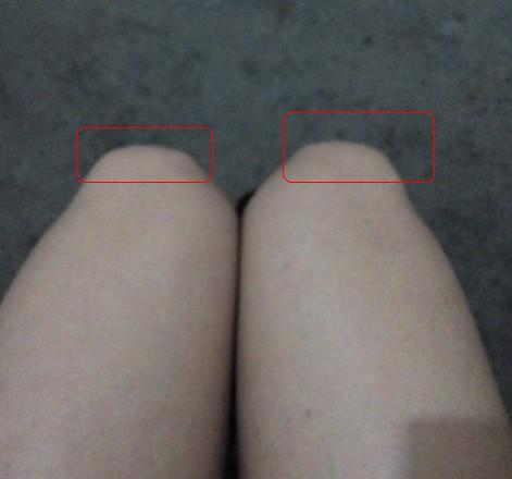 我膝盖为什么是歪的,而且腿型也不好,做一