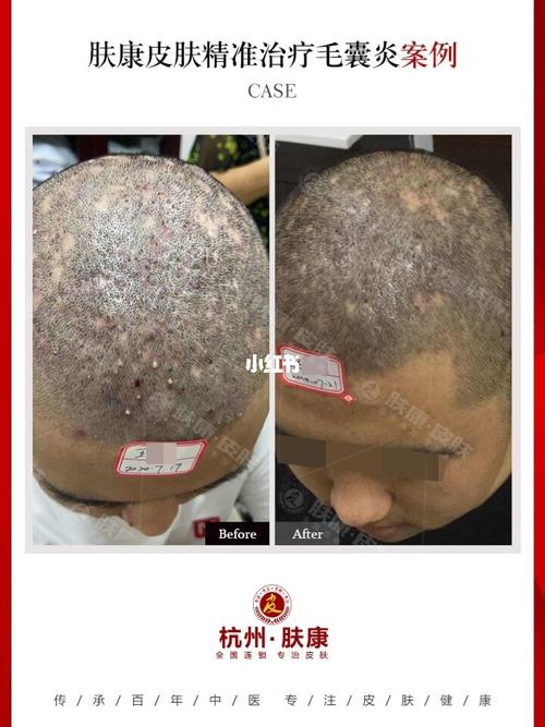 头部毛囊炎严重影响头发的生长,一定要及时_医疗健康