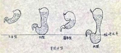胃有四种类型,你属于哪一种