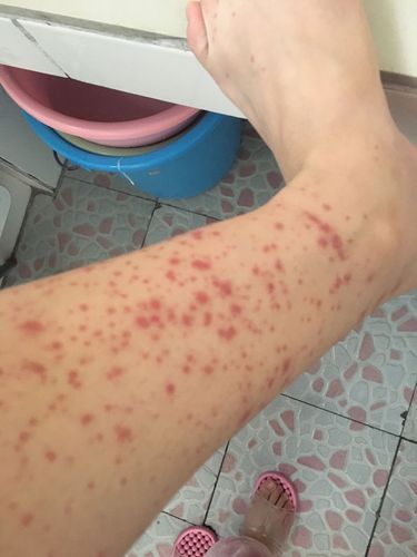 皮下出血要出什么药才能快速消去一块块和一点点的小红点