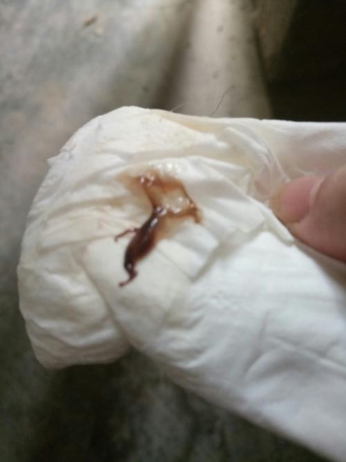 连续三天都有这样的褐色分泌物,谁能告诉我这是怎么了