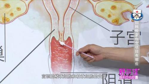 简单易懂的宫颈癌筛查介绍