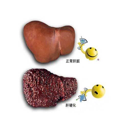 肝硬化-2018临床执业医师考试《消化系统》精华考点",方便大家对临床