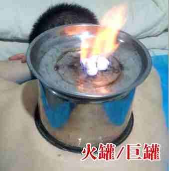 拔火罐-巨罐
