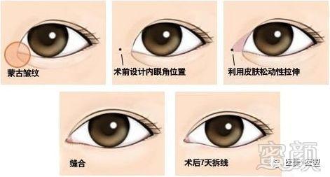 您真正的了解"开眼角"吗?