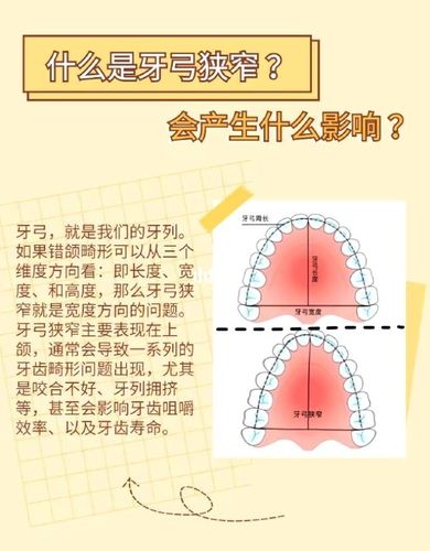 什么是牙弓狭窄?会产生什么影响?_美可美牙科(隐适美)