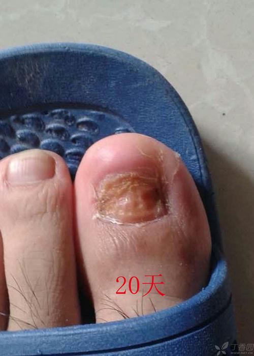 拔甲术后新趾甲生长图