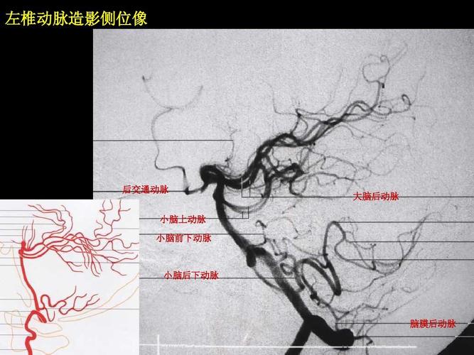左椎动脉造影侧位像 后交通动脉 小脑上动脉 小脑前下动脉 大脑后动脉
