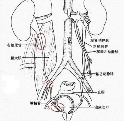 临床医学图库输尿管结石的好发部位