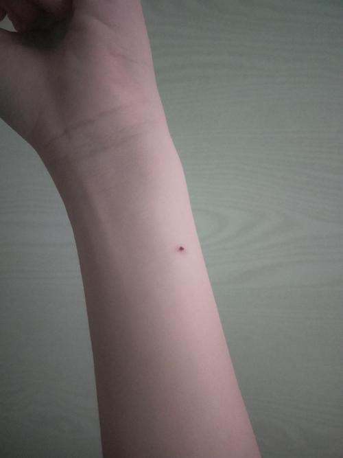 哇 我的ppd皮试好像长水泡了 哇的一声大哭出来