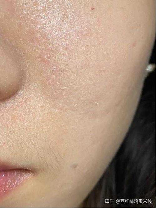 脸上皮肤干燥起皮怎么办?