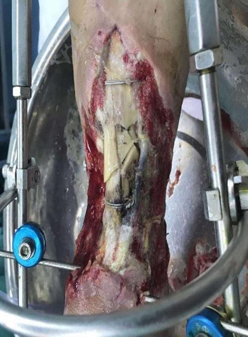 胫骨骨折不愈合合并骨缺损的主要原因