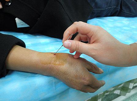 腱鞘炎      小针刀适用于注射治疗无效,以及有弹响或闭锁现象的腱鞘