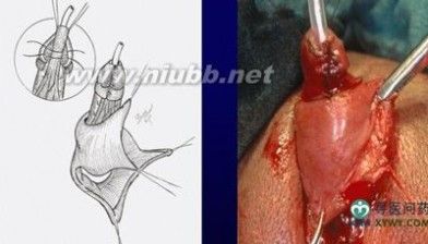 [变性手术女变男过程图]女变男变性手术全程高清图
