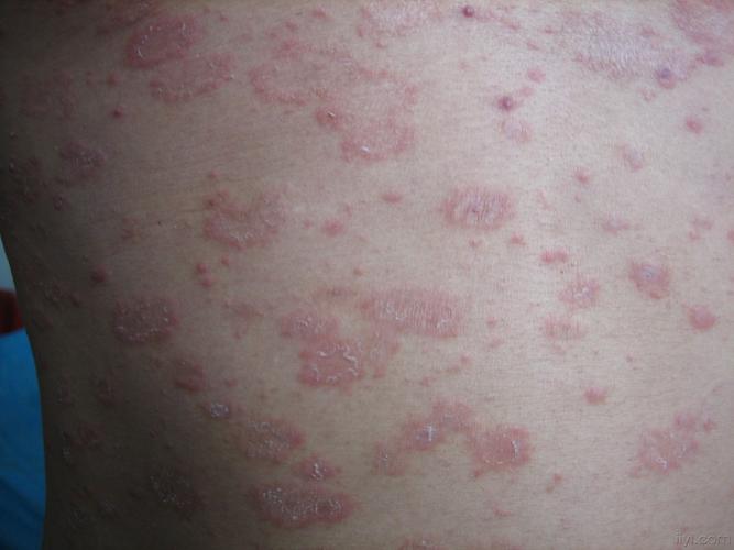典型的玫瑰糠疹