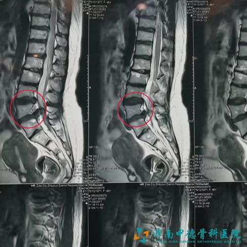 腰椎间盘突出的突出物髓核你知道长啥样吗