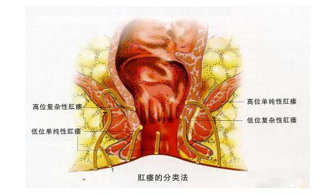 为什么连医生都怕患者得肛瘘?