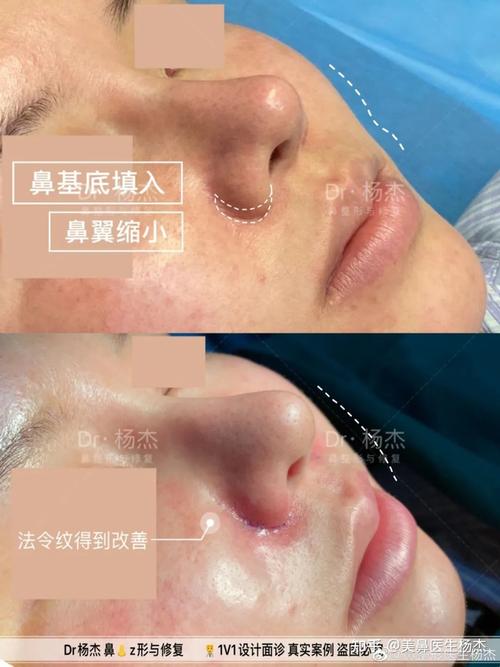 鼻基底凹陷常见问题解答