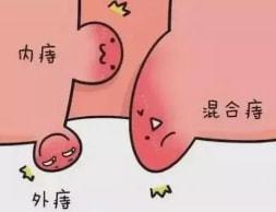 便血是痔疮肛裂还是肠癌咋判断痔疮咋来的肛周脓肿又是啥想要肠痔久安