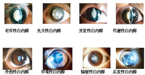 早期白内障的症状分析