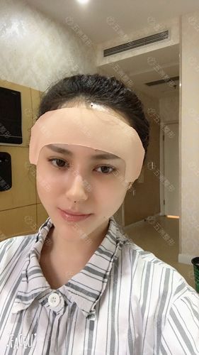 喜欢这样,脸上饱满的样子,肉肉肉的,就期待拆了绷带额头是什么样子了