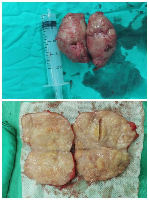 经耻骨上膀胱切开前列腺摘除术(170g前列腺)