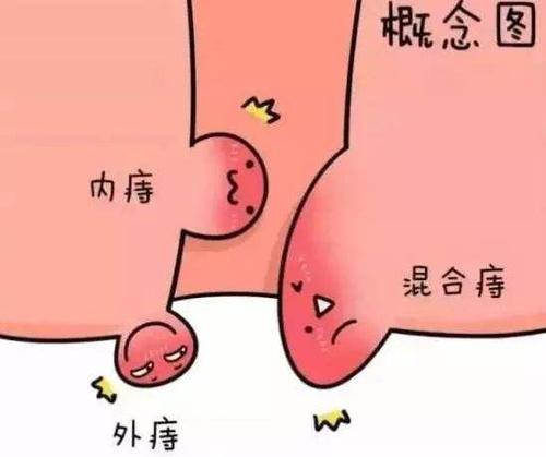 轻微痔疮的分类有哪些?吃什么药好得快?