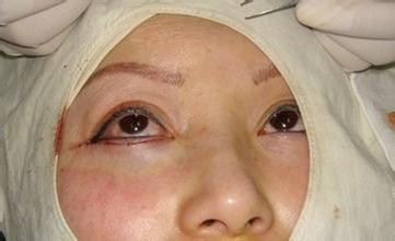 手术去眼袋案例