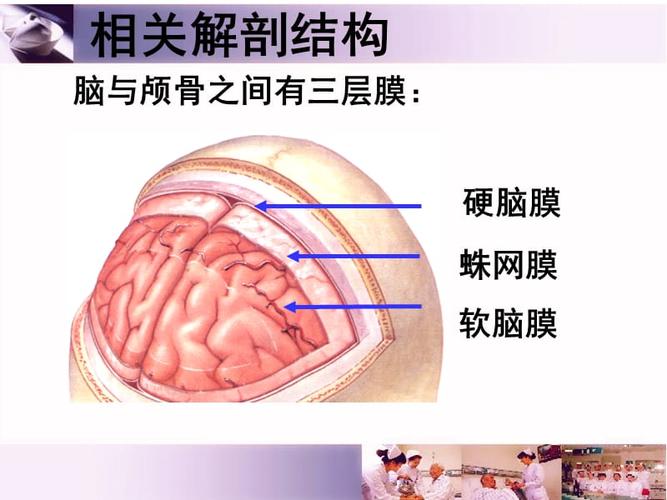 蛛网膜下腔出血医学课件.ppt