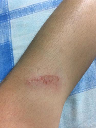 腿磕伤如何处理 14 2010-08-12 押腿押伤了,该怎么处理 2010-12-07 腿