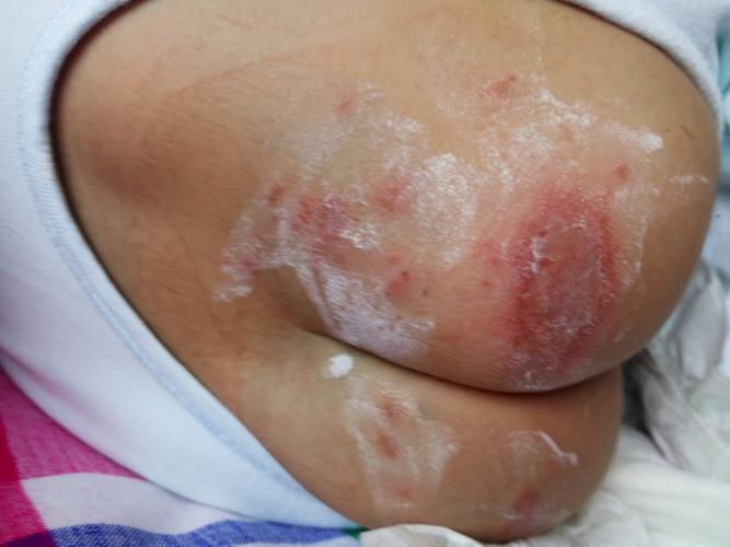 应该积极带宝宝到皮肤科就医专科治疗为妥