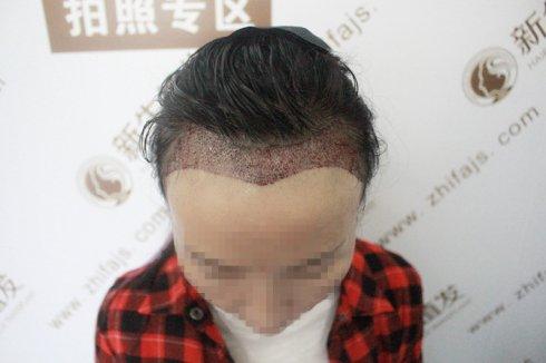 发际线高,在广州新生植发令我脱胎换骨