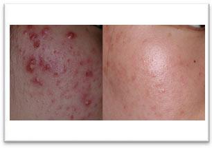 无锡什么方法祛痘效果好