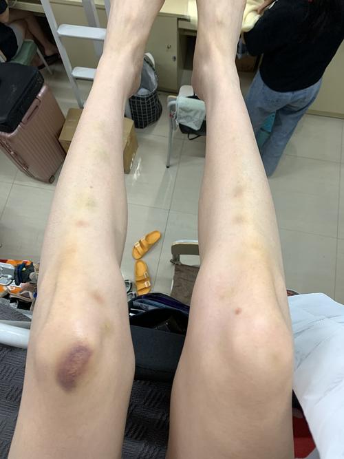 腿上莫名其妙很多淤青怎么回事