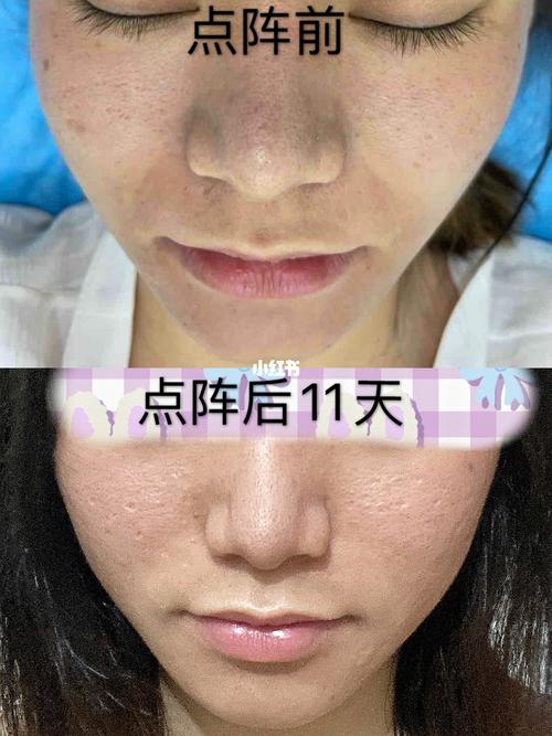 点阵激光前/后图片对比和恢复经验分享_点阵激光_粉刺_白头_痘坑_防晒