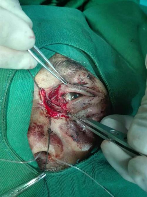 眼睑全层撕裂伤伴上下泪小管根部断裂疑难病例—于我院眼科成功手术