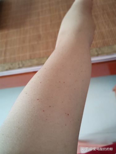 樱桃状血管瘤7年了被自己丑哭的手臂