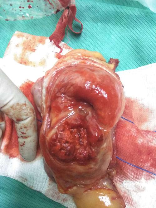 切除整个膀胱和肿瘤组织.