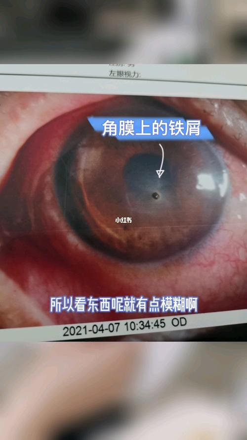 眼睛进了铁屑,一定要及时取出_护眼_保护眼睛_医疗健康_医疗健康其他
