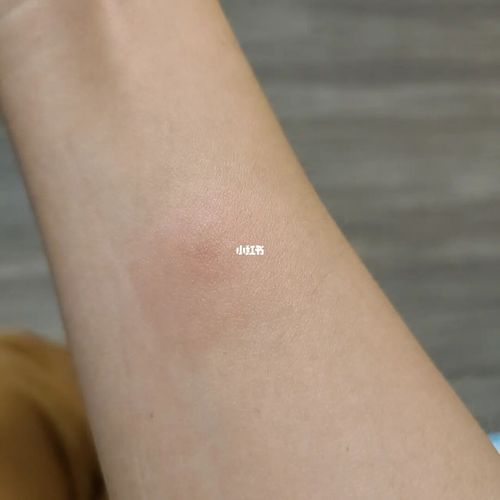 试管前结核抗体ppd皮试过关_垃圾桶_多囊_月经_阴超_穿衣_试管之路