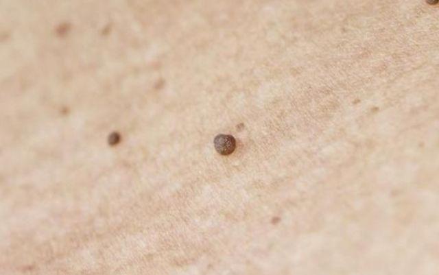 原创皮肤上长出"小肉球"不痛也不痒,可能是有疾病在作祟,别忽视