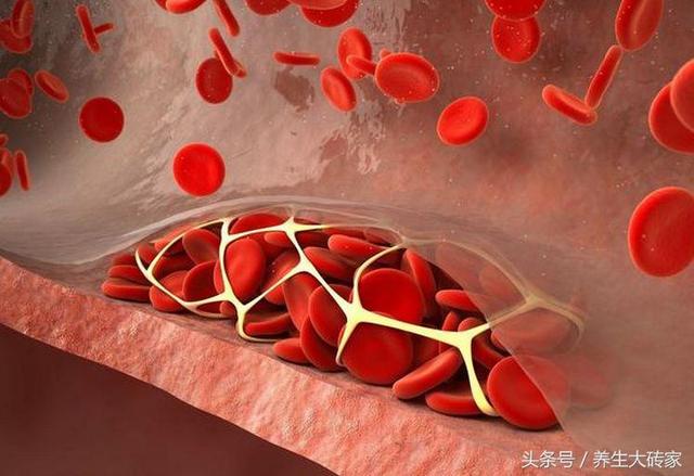 5个信号提示血液粘稠,需警惕血栓的形成,这3种食物要戒掉!
