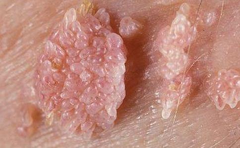 要是男性得了尖锐湿疣怎么看得出来呢可以已回复