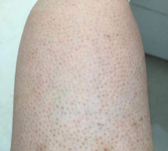 毛囊被过厚的角质堵塞了,而引起的一种慢性毛囊角化性皮肤病