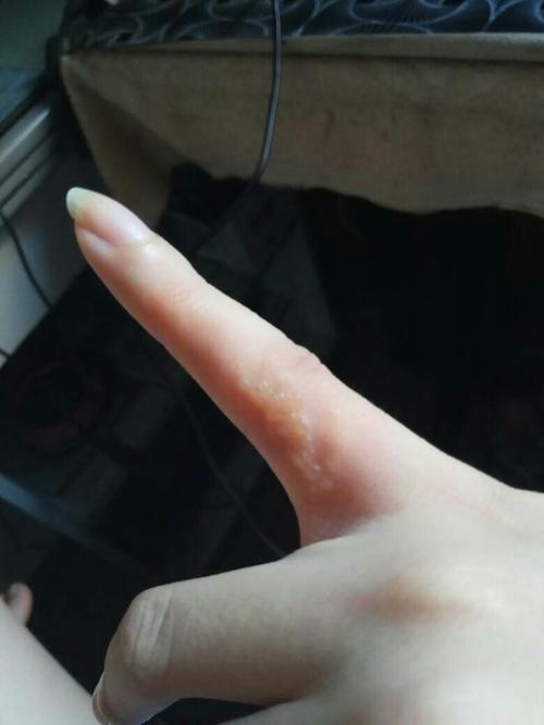 手指起了一些小泡泡,是皮藓嘛?好像之前贴过创口贴是粘的那个过敏嘛