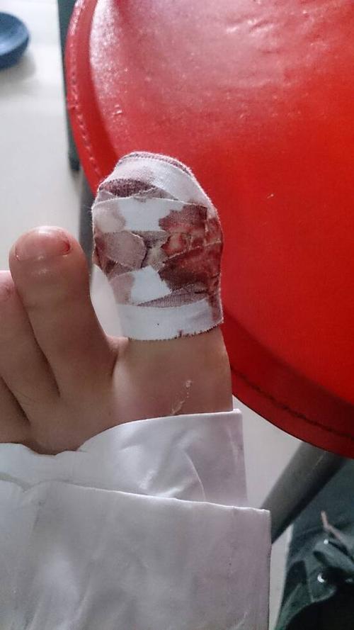 昨晚骑车不小心摔倒了,大拇脚趾盖全掉了,到医院清理消炎包扎了,晚上