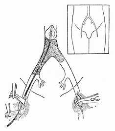 第74章急性动脉栓塞